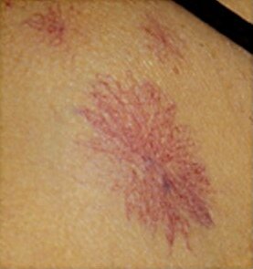 horumcek-angioma