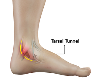 tarsal-tunel-sindromu