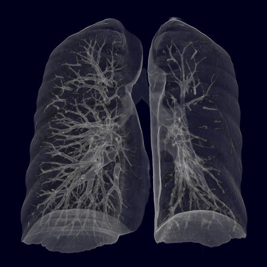 swyer-james-sindromu