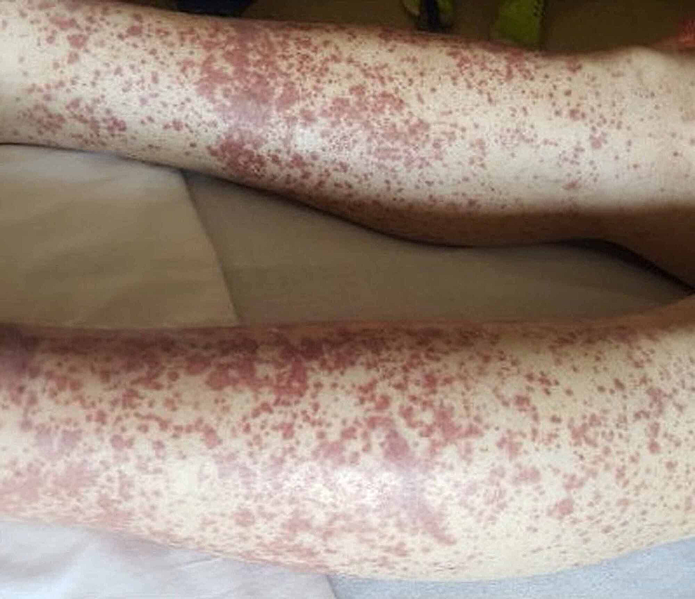serum-xesteliyi-benzer-reaksiyalar