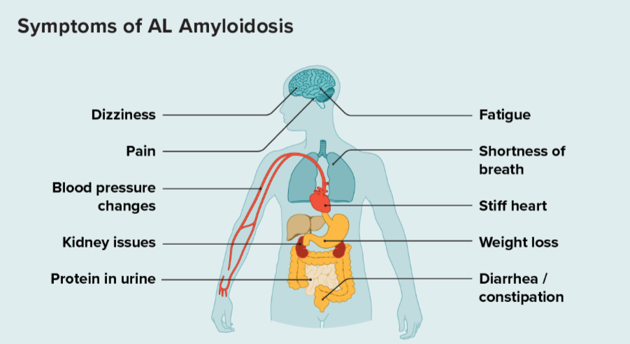 amiloidoz